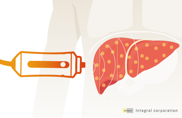 （フィブロスキャンを使った肝硬度測定: 株式会社インテグラルHPより）
