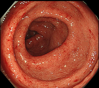 代表的な潰瘍性大腸炎の内視鏡所見