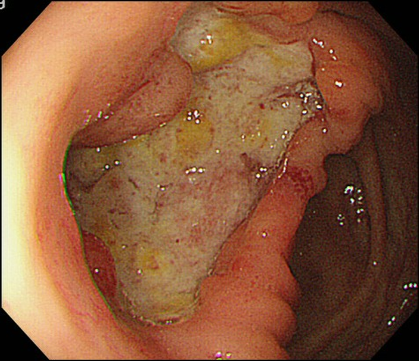 代表的な腸管ベーチェット病の内視鏡所見