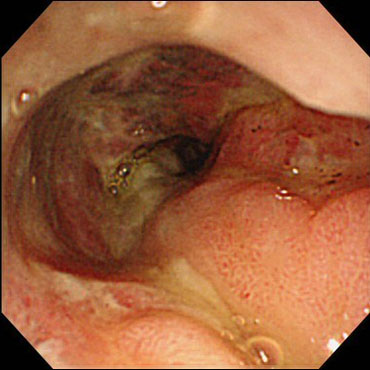 図2-2. 胃十二指腸閉塞における消化管造影検査、内視鏡検査